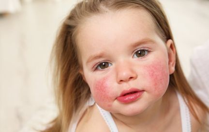 Атопический дерматит у детей