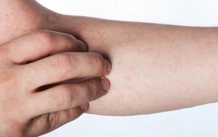 Геморрагическая сыпь